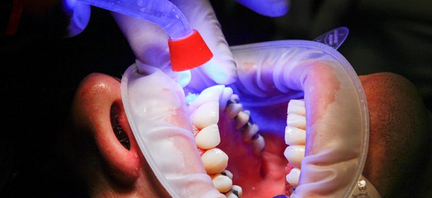מתי מתאים להשתמש בציפוי קומפוזיט לשיניים?